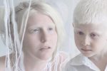 Kondisi Genetik Albino Yang Terjadi Pada Seseorang