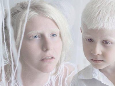Kondisi Genetik Albino Yang Terjadi Pada Seseorang