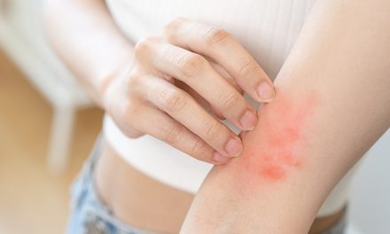 Kondisi Alergi Maupun Gatal Di Sebabkan Oleh Banyak Hal