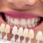 Estetika Gigi Melalui Cara Veneer Ke Dokter