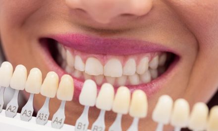 Estetika Gigi Melalui Cara Veneer Ke Dokter