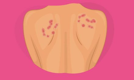 Pengobatan Herpes Genital Lewat Pola Hidup Sehat