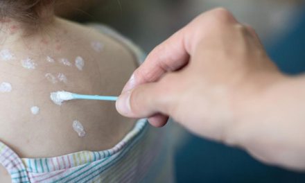 Cara Cepat Hilangkan Bekas Cacar Pakai Bahan Rumahan