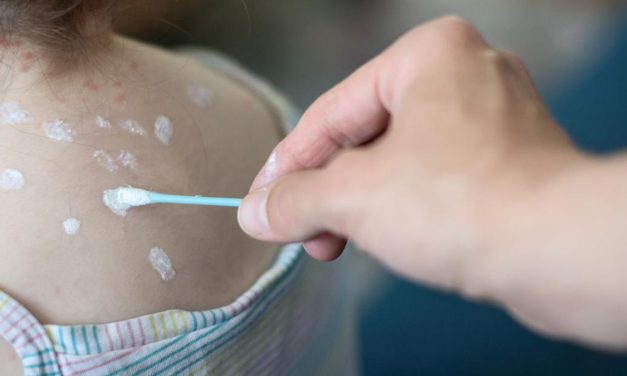 Cara Cepat Hilangkan Bekas Cacar Pakai Bahan Rumahan
