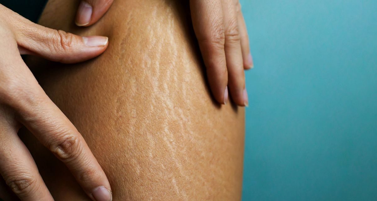 Pilihan Produk Terbaik Buat Pudarkan Stretch Mark