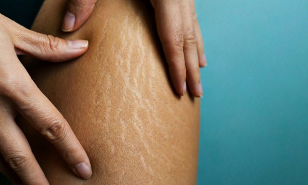Pilihan Produk Terbaik Buat Pudarkan Stretch Mark