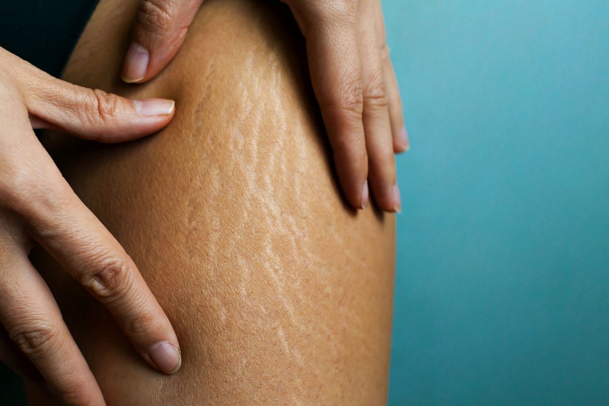 Pilihan Produk Terbaik Buat Pudarkan Stretch Mark